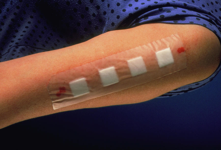 Single-use ink caps and sterile syringes for contamination prevention.