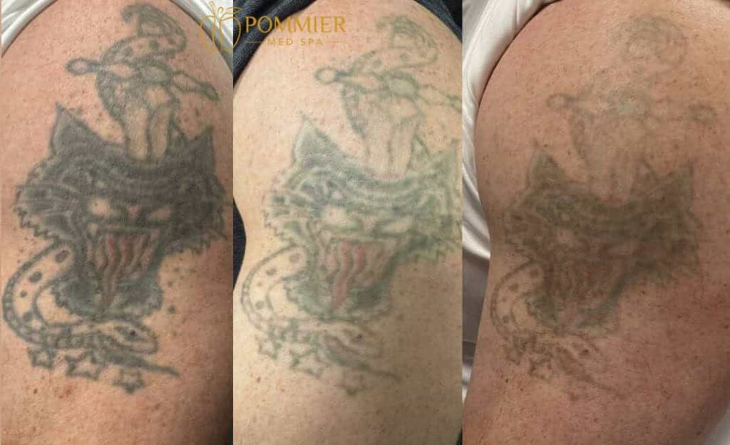 Hình ảnh so sánh kết quả cover-up có laser (trái) và không laser (phải)