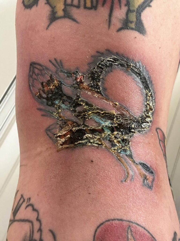 Ankle tattoos often swell more due to gravity and poor circulation.